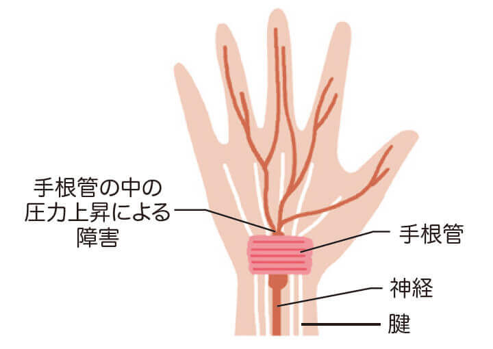 手根管症候群イラスト