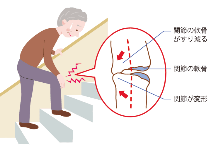 変形性関節症イラスト