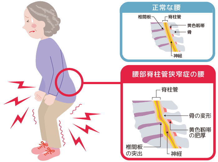 「正常な腰」と「腰部脊柱管狭窄症の腰」図解